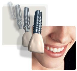 dental-implants-diagram